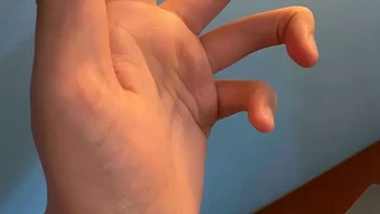 ari tangan ini memiliki sendi tengah yang tidak biasa, membuat bentuk dan cara jari tersebut menekuk terlihat berbeda dari kebanyakan orang. Foto: via Boredpanda
