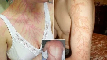 Garis kemerahan bercabang yang terlihat di kulit ini menyerupai akar atau kilatan petir. Pola semacam ini dikenal sebagai Lichtenberg figure, yang dapat muncul setelah tubuh terkena sambaran atau pelepasan listrik bertegangan tinggi. Foto: via Boredpanda