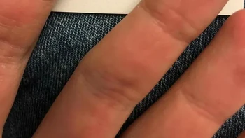 Orang ini terlahir tanpa sidik jari tangan atau kaki. Kondisi tini dinamakan Adermatoglifia (Adermatoglyphia). Kondisi yang sangat langka ini sering dijuluki sebagai immigration delay disease karena penderitanya kerap mengalami kesulitan saat melewati pemeriksaan paspor atau verifikasi identitas biometrik di bandara. Foto: via Boredpanda