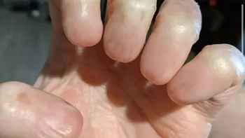 Sekilas seperti jari biasa, tetapi seluruh kuku pada tangan ini tampak tidak terbentuk. Kondisi tidak adanya kuku dikenal sebagai anonychia dan bisa terjadi sejak lahir. Foto: via Boredpanda