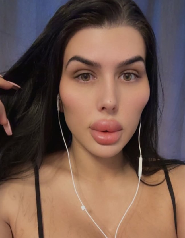 Sofia Lips, dikenal karena memiliki bibir tebal tidak natural hasil dari filler hingga dijuluki sebagai bibir terbesar di Inggris’. Kini, wanita 28 tahun itu membuat sensasi mengejutkan dengan mengatakan bahwa ia enyuntikkan filler sendiri di rumah setelah sejumlah klinik menolak melakukan prosedur tambahan pada bibirnya. Foto: dok. Instagram Sofia Lips