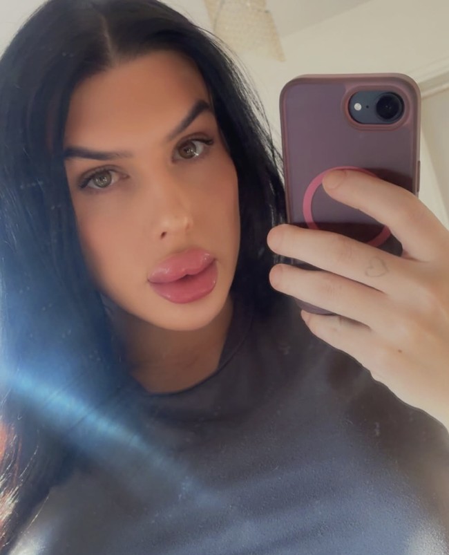 “Aku sangat puas dengan hasilnya sampai merasa siap melakukannya pada orang lain. Awalnya bibirku sangat meregang sampai aku kesulitan makan dan minum. Beberapa hari kemudian hanya terasa sedikit nyeri,” katanya. Foto: dok. Instagram Sofia Lips