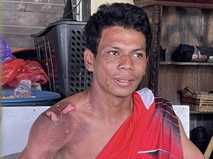 Relawan Maulana Adi Saputra (20) mengalami luka bakar saat melindungi rumah warga dari karhutla di kalte. (dok Istimewa)