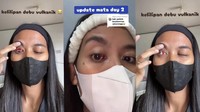 Cerita Warga Alami Pembuluh Darah Pecah di Mata usai Kelilipan Abu Vulkanik