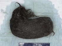 Gumpalan Rambut 1,5 Kg Bersarang di Perut Gadis 16 Tahun