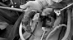Penampakan Gumpalan Rambut 1,5 Kg yang Diangkat dari Perut Gadis 16 Tahun