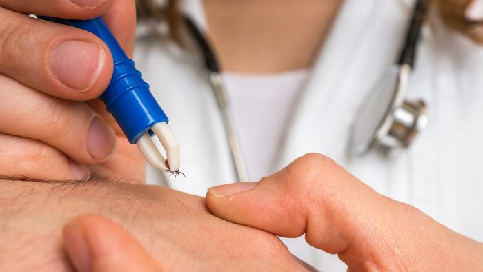 Female doctor removing a tick with tweezers from hand of patient. Encephalitis, borreliosis and lyme disease.