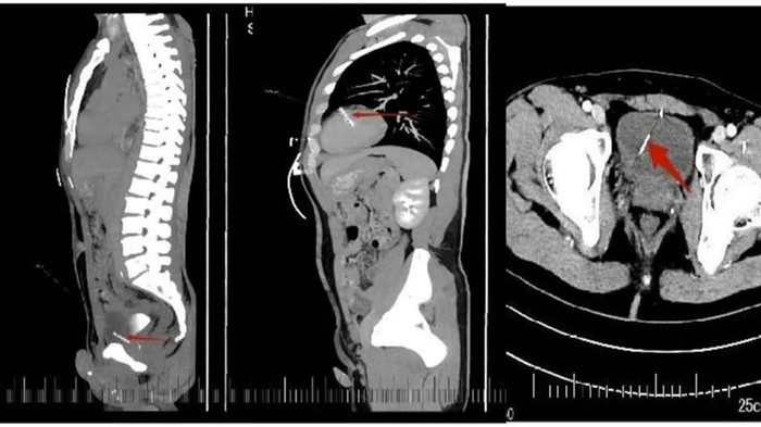 Bikin Ngilu! Jarum Jahit Sepanjang 3,6 Cm Nyangkut di Jantung Pria Ini