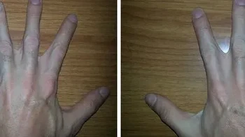 Jari berselaput di kedua tangan. Pria ini memiliki jari yang menyatu atau berselaput pada kedua tangannya. Keunikan tersebut terlihat jelas pada sela beberapa jarinya. Foto: via Boredpanda