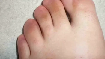 Kaki tanpa kuku jari. Jika biasanya setiap jari kaki memiliki kuku, orang ini memperlihatkan kondisi yang berbeda. Jari-jari kakinya tampak tidak memiliki kuku. Foto: via Boredpanda