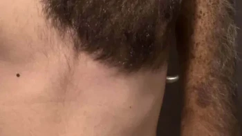 Nevus kongenital berukuran besar. Orang dalam foto ini mengatakan dirinya terlahir dengan giant congenital nevus atau nevus kongenital berukuran besar. Area tersebut terlihat ditumbuhi rambut lebat di sebagian dada, bahu dan lengannya. Foto: via Boredpanda