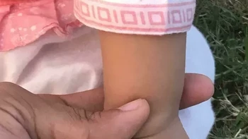 Enam jari di kedua tangan. Anak ini terlahir dengan enam jari pada masing-masing tangannya. Kondisi memiliki jari tambahan dikenal sebagai polidaktili. Foto: via Boredpanda