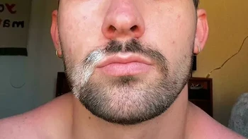 Vitiligo sekaligus heterochromia. Orang ini terlahir dengan heterochromia dan mulai mengalami vitiligo ketika berusia sekitar 8-9 tahun. Ia mengaku dulu tidak menyukai kondisinya, tetapi kini telah belajar menerima dan mencintai penampilannya. Foto: Bored Panda