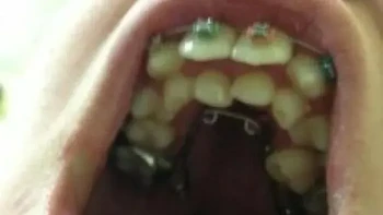 Gigi tumbuh dalam dua baris. Foto ini memperlihatkan susunan gigi yang tidak biasa, dengan gigi permanen tumbuh sementara gigi susu masih bertahan sehingga tampak seperti memiliki dua baris gigi. Kondisi semacam ini kadang dijuluki shark teeth.Foto: via boredpanda