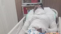 Malangnya Sopir di Bali Dibakar Bos, Luka 68% dan Tak Bisa Bayar Perawatan