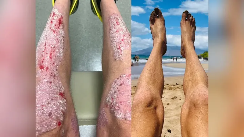 Jalani 'Lion Diet', Pria Ini Klaim Sembuh dari Psoriasis Parah Jalani 'Lion Diet', Pria Ini Klaim Sembuh dari Psoriasis Parah