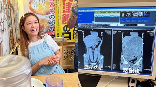 Youtuber sekaligus bintang mukbang asal Taiwan, Xiao Hui (24), membuat warganet merinding usai membagikan hasil foto pemindaian CT scan perutnya.