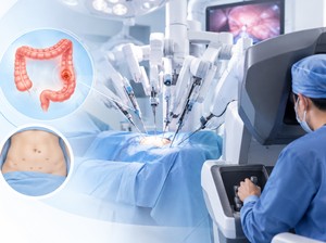 Kanker Usus Besar Bisa Dioperasi dengan Robotik, Kapan Metode Ini Dipilih?
