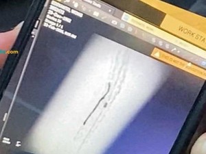 Video: Kemenkes Investigasi soal Ada Kawat Tertinggal di Jantung Pasien