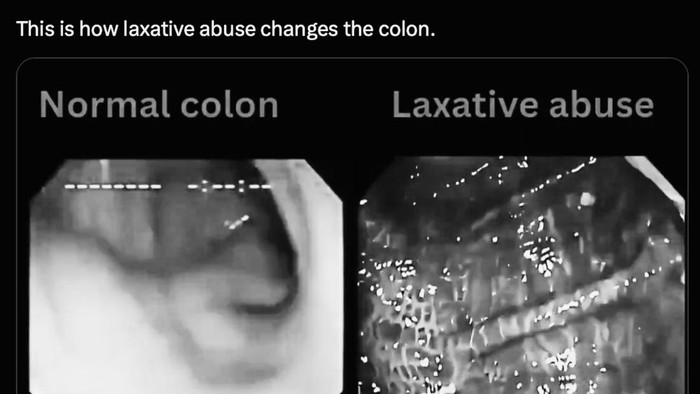 Laxative Abuse