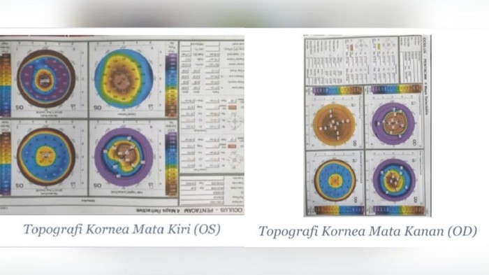Kisah pria 26 tahun asal Kabupaten Sukabumi berjuang melawan keratoconus dan membutuhkan donor kornea.