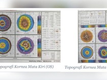 Pria 26 Tahun di Sukabumi Berjuang Lawan Keratoconus, Menanti Donor Kornea