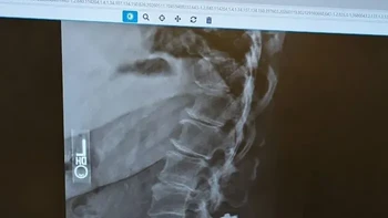 Baru berusia 23 tahun, orang ini sudah harus menjalani operasi tulang belakang. Bantalan antarruas tulang belakangnya mengalami kerusakan, herniasi, sekaligus robekan. Meski nyeri kronisnya belum hilang, operasi membuat tulang belakangnya lebih leluasa bergerak. Foto: Boredpanda