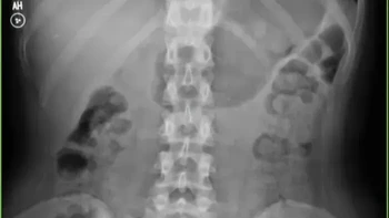 Begini penampakan perut seseorang yang mengalami sembelit selama dua minggu. Foto rontgen memperlihatkan penumpukan material di sepanjang usus besar. Kondisi ini menunjukkan betapa seriusnya sembelit jika berlangsung berkepanjangan. Foto: Boredpanda