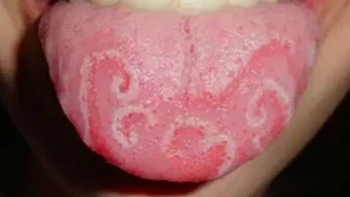 Lidah dengan pola unik seperti peta dunia ini bukan hasil editan. Kondisi yang dikenal sebagai geographic tongue atau lidah geografis menyebabkan munculnya bercak kemerahan dengan tepi tidak beraturan. Kondisi ini umumnya tidak berbahaya. Foto: Boredpanda