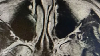 Pantas saja sering sakit kepala dan mengalami gangguan tidur! Hasil CT scan memperlihatkan sekat hidung seseorang yang bengkok atau deviated septum. Pemiliknya menduga kondisi ini menjadi penyebab sakit kepala berkepanjangan dan sleep apnea yang dialaminya. Foto: via Borenpana