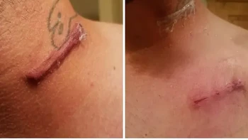 Dua bekas luka operasi di leher dan dada ini merupakan bagian dari pemasangan alat stimulasi saraf vagus atau Vagus Nerve Stimulation (VNS). Perangkat yang ditanam di bawah kulit tersebut mengirimkan impuls listrik melalui saraf vagus untuk membantu menangani kondisi medis tertentu, termasuk epilepsi. Foto: Bored Panda. Foto: via Borenpana