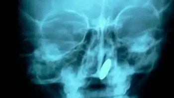 Bocah berusia lima tahun ini nekat memasukkan uang logam ke hidungnya. Koin tersebut ternyata bergerak hingga ke rongga sinus, sehingga dokter harus mengeluarkannya melalui tenggorokan. Foto rontgen memperlihatkan posisi koin yang tersangkut di dalam kepalanya. Foto: via Borenpana