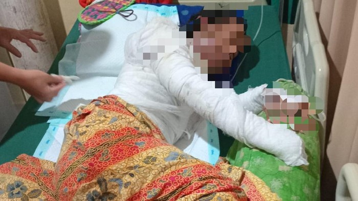 Istri di Lampung yang dibakar oleh suaminya sedang menjalani perawatan di rumah sakit