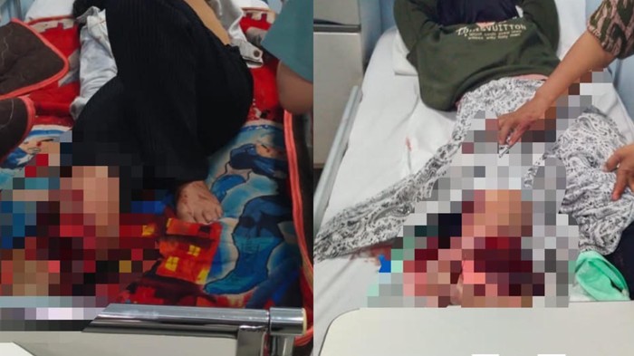 Kaki dua mahasiswi terpaksa diamputasi usai tertimpa pohon kontainer truk yang terjatuh usai menabrak pohon di Takalar.
