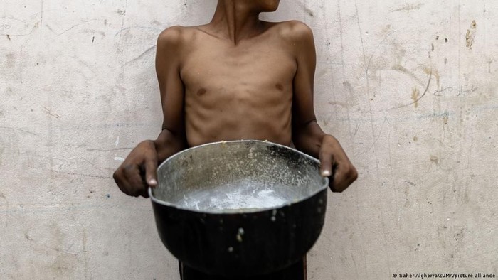 Foto Saher Alghora tentang pengungsi anak Gaza yang mengalami malnutrisi akibat perang. Foto ini memenangkan penghargaan Pulitzer pada 2025 (Saher Alghorra/ZUMA/picture alliance)