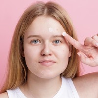Waspada 5 Kesalahan Penggunaan Acne Patch, Malah Bikin Jerawat Makin Parah