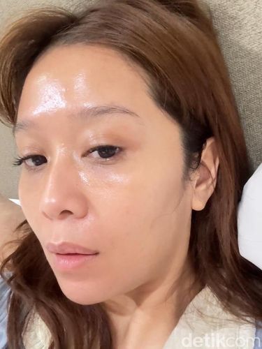 Mencoba Treatment Exosome, Ini Hasil Setelah 2 Minggu
