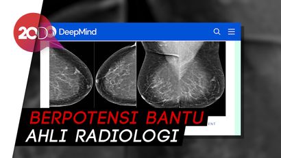 Teknologi AI Bantu Pemeriksaan Kanker Payudara
