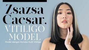 Zsazsa Caesar, Model Asal Bandung dengan Kondisi Kulit Vitiligo