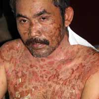 Warga Banyuwangi Terserang Penyakit Misterius Warga Banyuwangi Terserang Penyakit Misterius