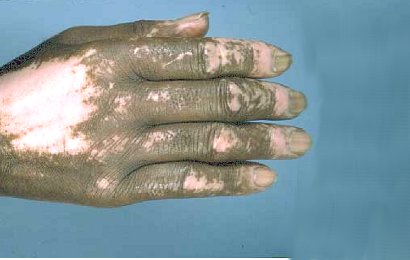 Scleroderma Scleroderma