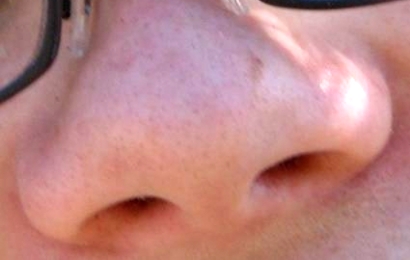 Anosmia Anosmia