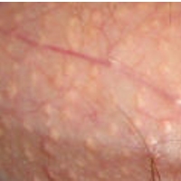 Benjol-benjol Kecil di Buah Zakar