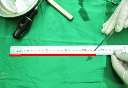 operasi bpjs epilepsi Ternyata Epilepsi, Ada Cm Otaknya di Cacing 23 Sering