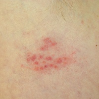 Granuloma Annulare, Benjolan Kecil Kemerahan pada Kulit Granuloma Annulare, Benjolan Kecil Kemerahan pada Kulit