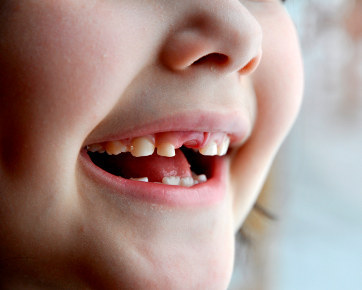 Ketika Gigi Si Kecil Mulai Goyang Tanggal