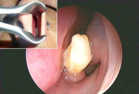 Hidung Berdarah Dikira Mimisan Ternyata Ada Gigi Tumbuh Di Hidung Pria Ini