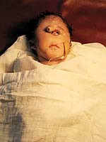 Bayi Bermata Satu Meninggal