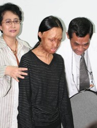 RSU dr Soetomo Gelar Operasi Face Off Selasa