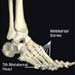 Cedera Metatarsal, Apa Itu?